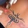 Tattooentfernung