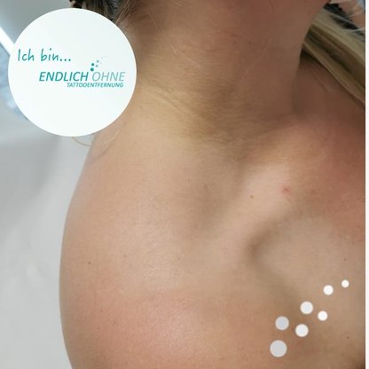 ENDLICH OHNE Tattooentfernung Stuttgart
