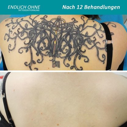 ENDLICH OHNE Tattooentfernung Stuttgart