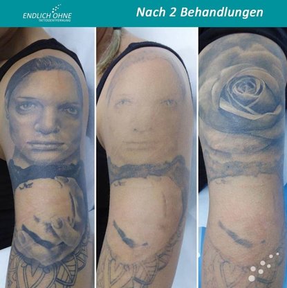 ENDLICH OHNE Tattooentfernung Stuttgart