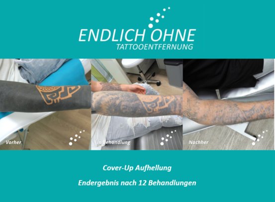 ENDLICH OHNE Tattooentfernung Stuttgart