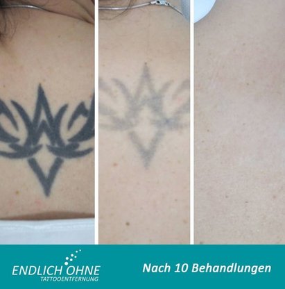 ENDLICH OHNE Tattooentfernung Stuttgart