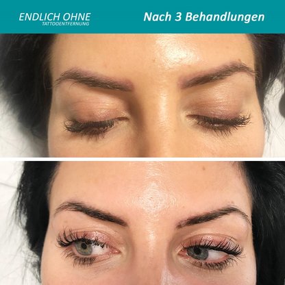 ENDLICH OHNE Tattooentfernung Stuttgart