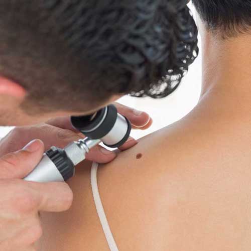 Besser vorsorgen: Wie ein Hautkrebs-Screening abläuft