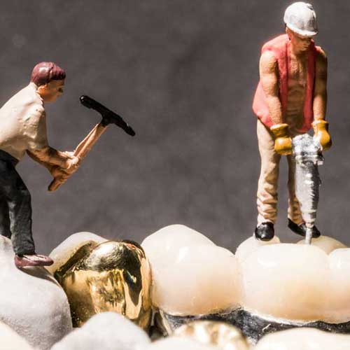 Zahnfüllungen im Vergleich: Zement oder Kunststoff, Gold oder Keramik?