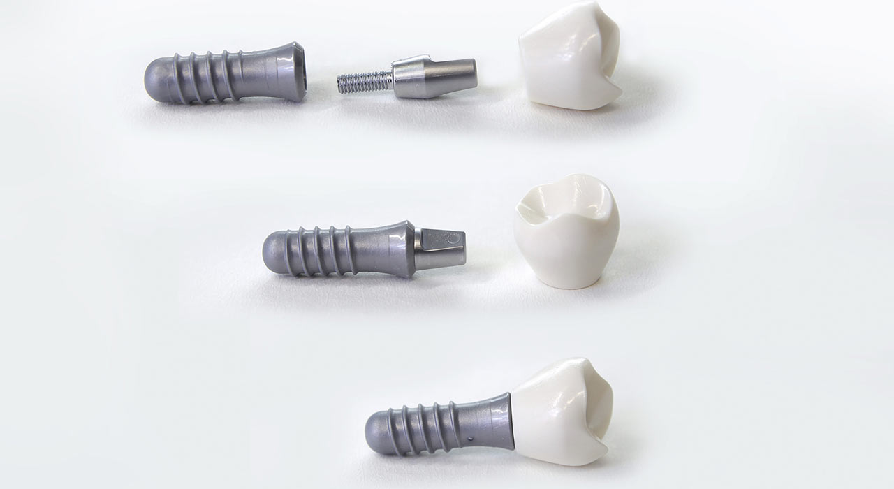 Implantate_303_Bild_1